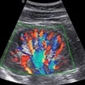 Color Doppler