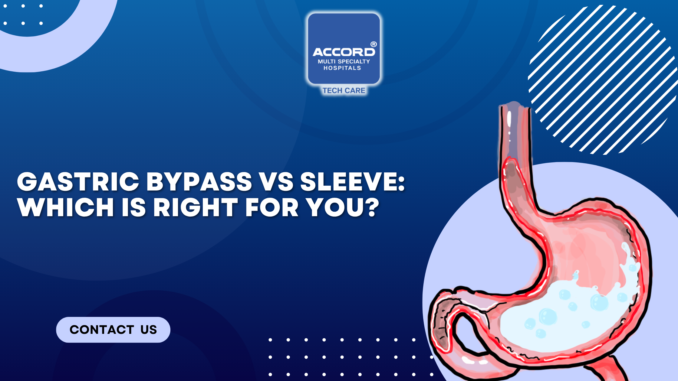 Gastric Bypass or Sleeve: Which One Fits Your Weight Loss Goals?